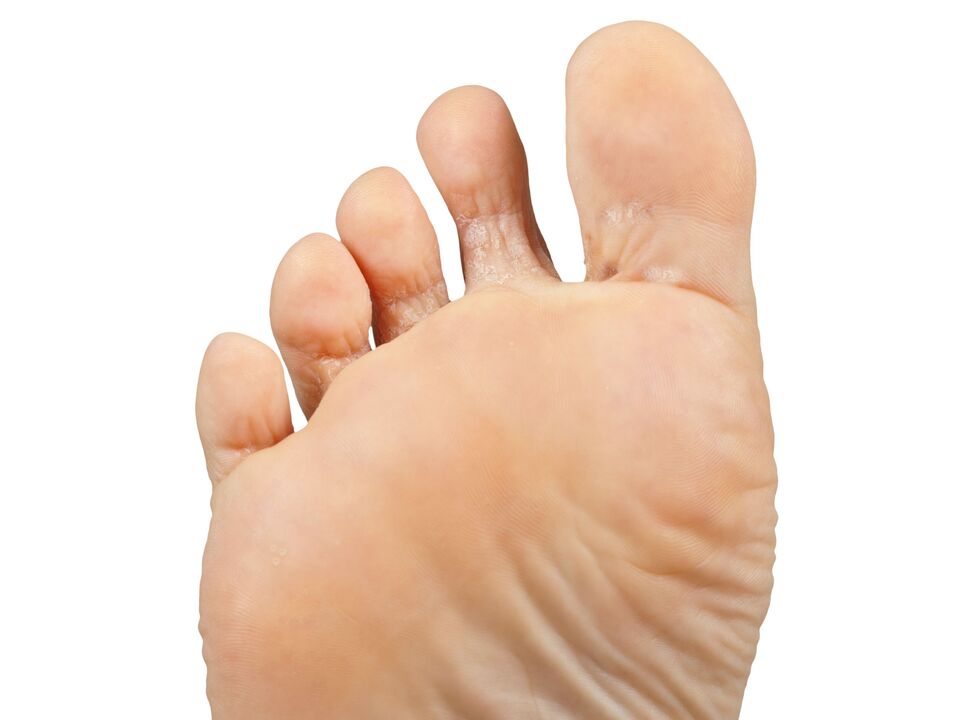 Funger-good-and-pair-and-and-ectic-cream-demyxil