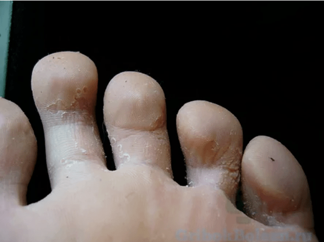 Τα στάδια του μύκητα